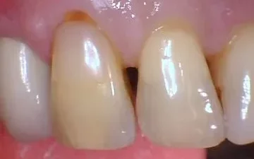 dental-bonding-before