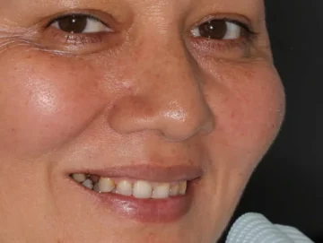 implant-before-01 implant-before-01