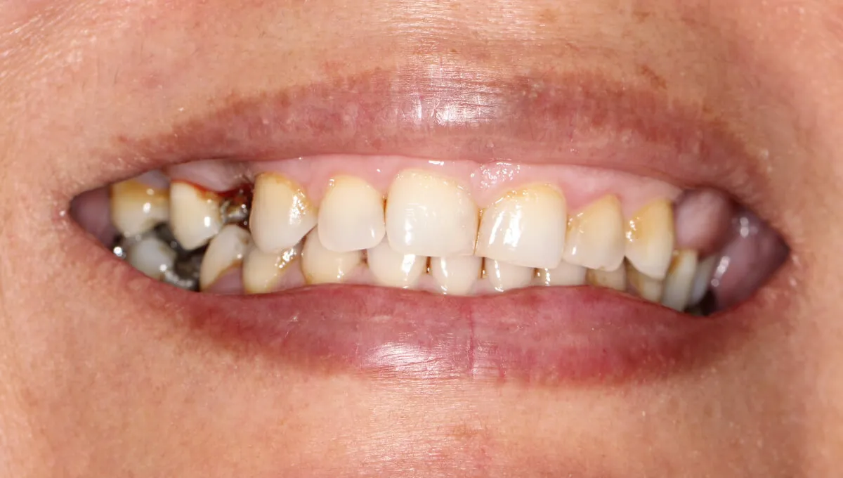 implant-before-02 implant-before-02