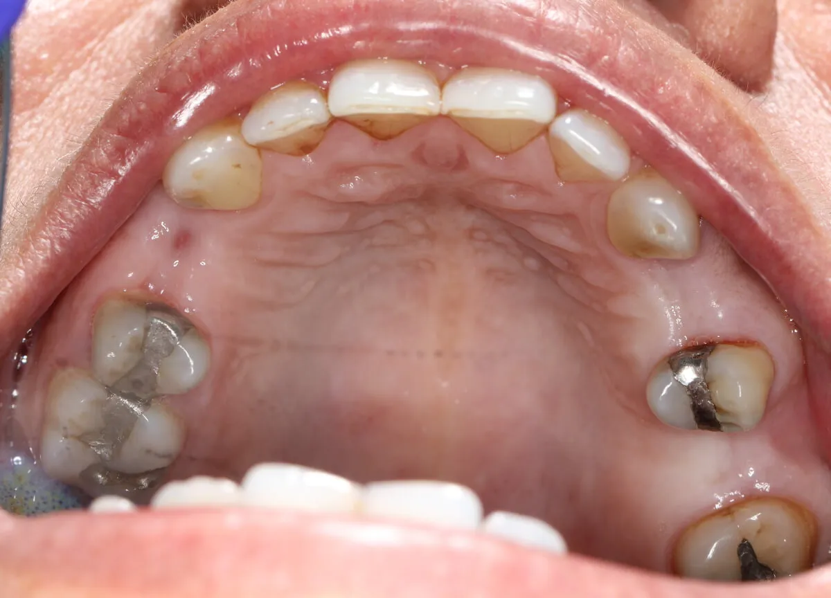 implant-before-03 implant-before-03