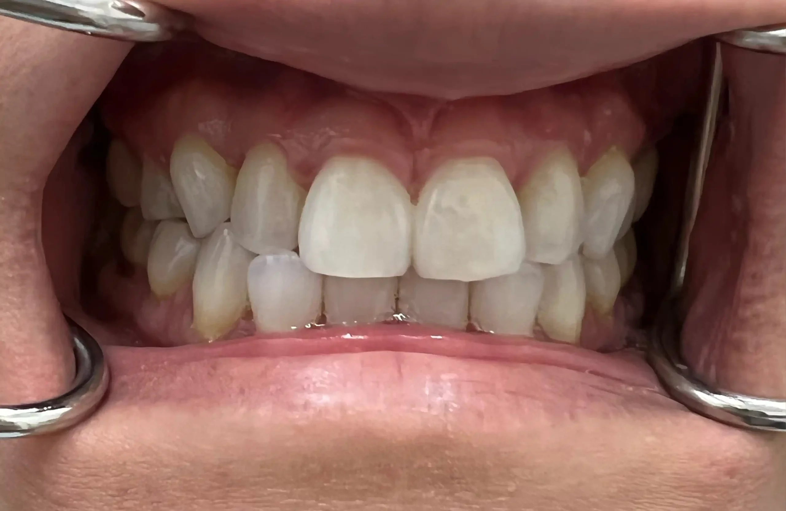 Ice_before-invisalign-2