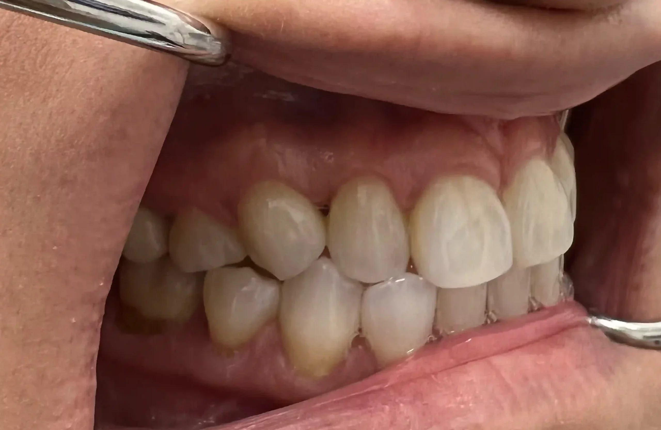 K_before-invisalign-1