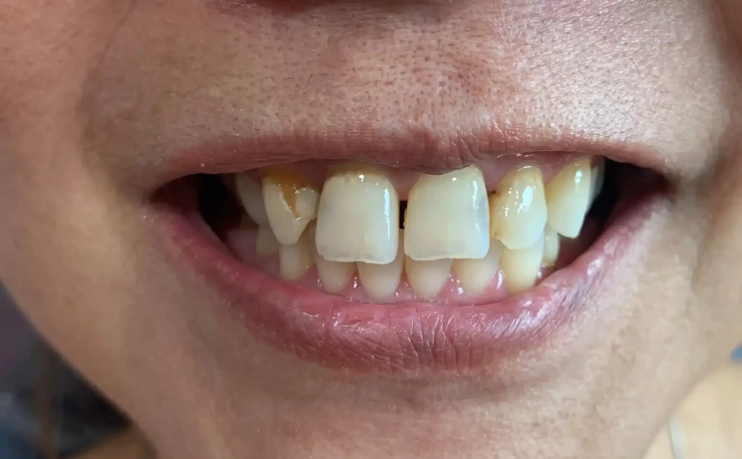 Lisa Before 2 (1) (1)