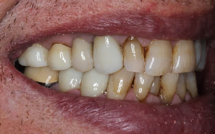 dental implantsafter-01