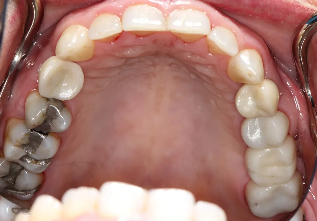 implant-04-after