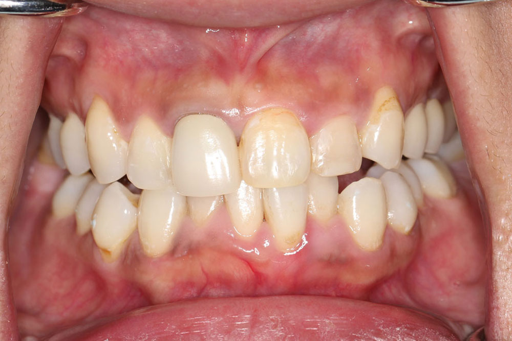 invisalign before2-1 01-2025